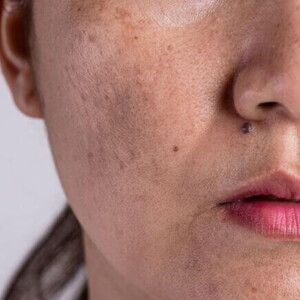 close-up de rosto feminino com manchas de cloasma visíveis na pele. close-up de rosto feminino com manchas de cloasma visíveis na pele.