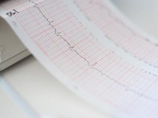 Cardiograma sendo impresso durante exame Cardiograma sendo impresso durante exame