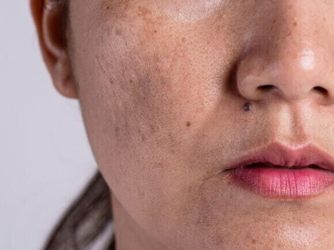 close-up de rosto feminino com manchas de cloasma visíveis na pele. close-up de rosto feminino com manchas de cloasma visíveis na pele.