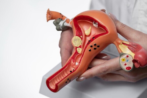 Imagem de um órgão reprodutor feminino para explicar a endometriose