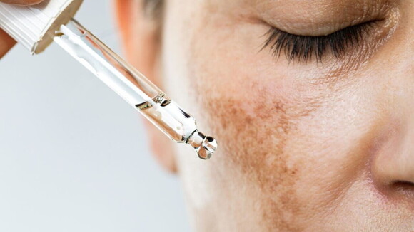 rosto feminino com manchas de cloasma enquanto um sérum é aplicado na pele. rosto feminino com manchas de cloasma enquanto um sérum é aplicado na pele.