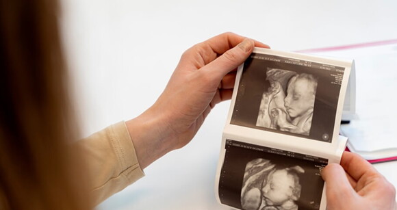 Mulher segurando imagens de ultrassonografia neonatal de bebê com Síndrome de Patau. Mulher segurando imagens de ultrassonografia neonatal de bebê com Síndrome de Patau.